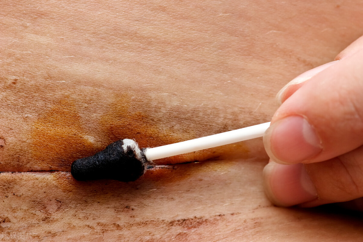 剖宫产疤痕如何看是恢复的比较好,剖宫产疤痕憩室怎么去除