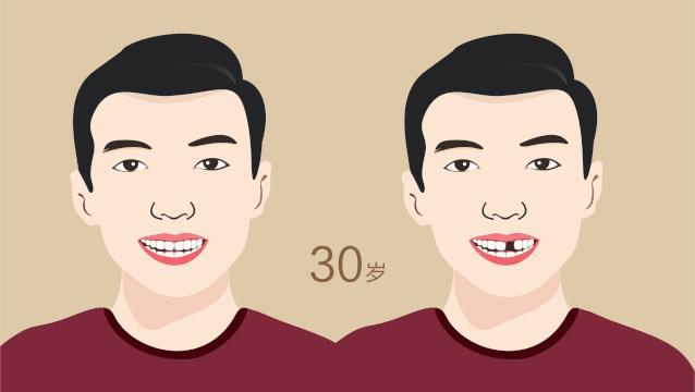 老人缺牙哪种活动义齿好,活动假牙和固定假牙哪个比较好