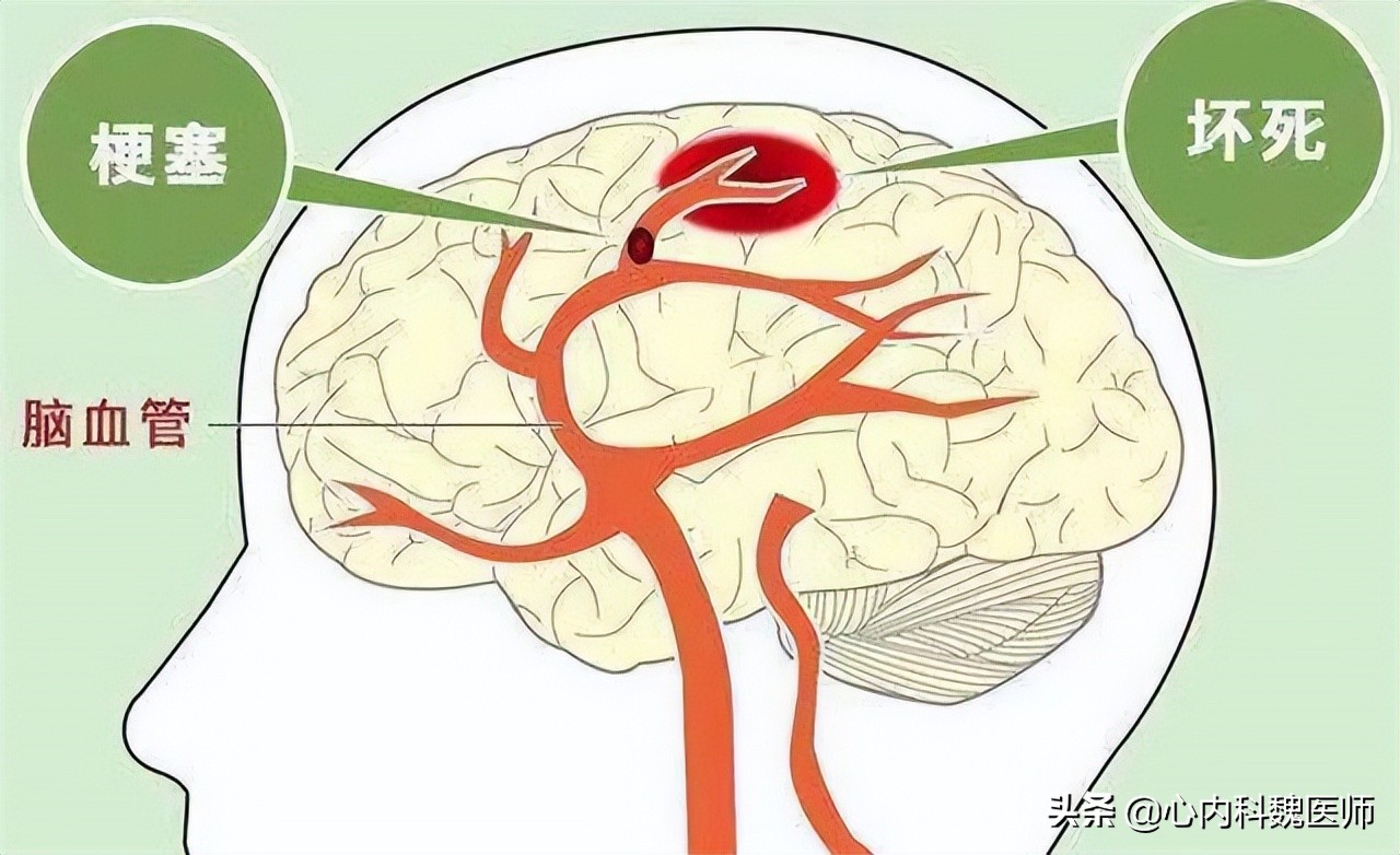 颈动脉斑块多大容易得脑梗,发现颈动脉血栓就离脑梗不远了