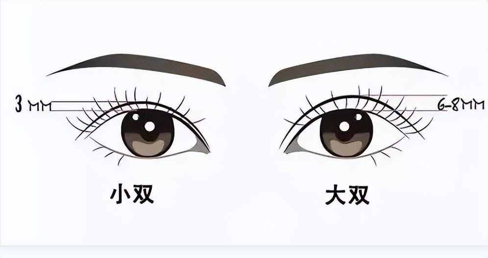 双眼皮做埋线疼吗,双眼皮全切疼几天