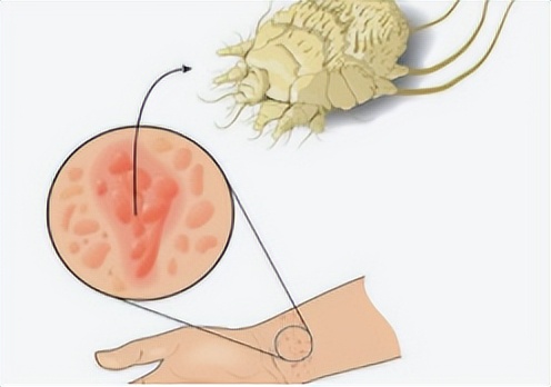 疥疮会引起腹痛吗,灼热疼痛怎么回事