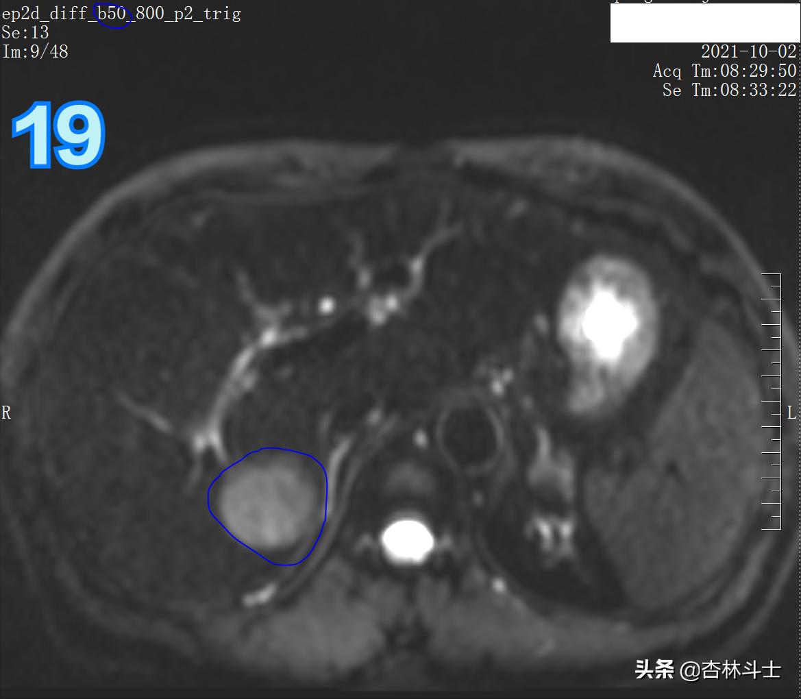 肝癌8公分肿瘤能活多久,肝癌细胞最大长多大