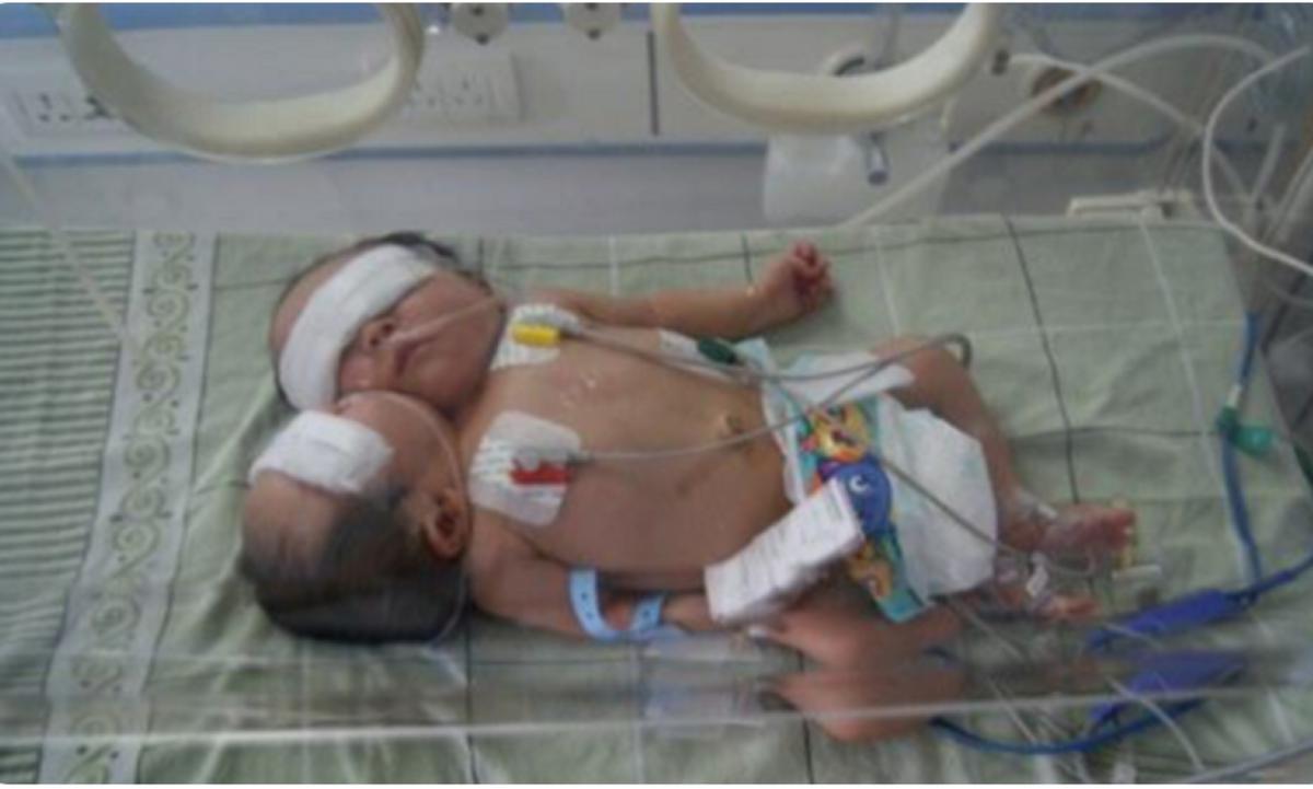 女孩去做体检发现怀了四胞胎,女子怀双胞胎竟是被遗传