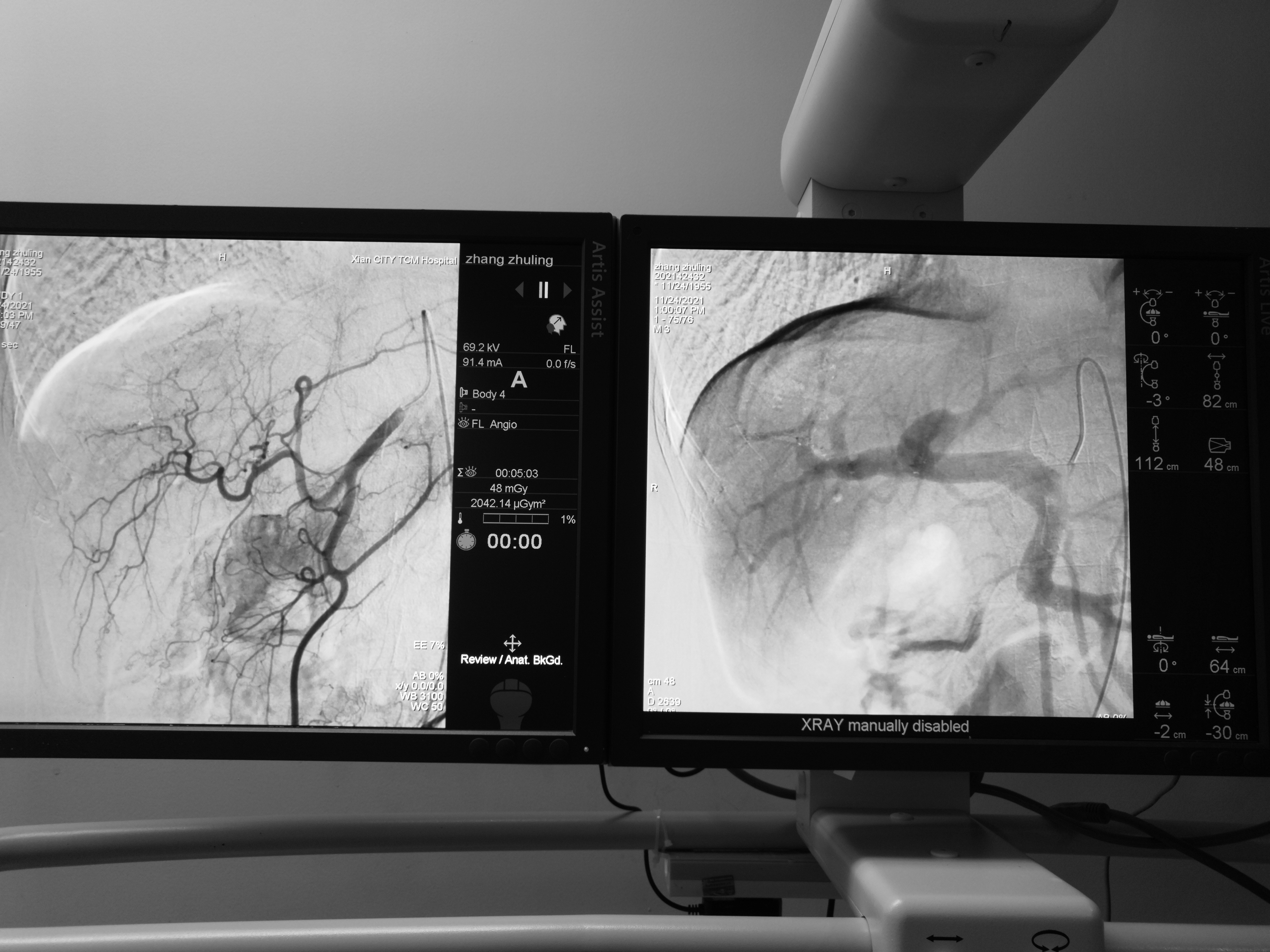 肠癌肝转移先做化疗还是介入,肠癌肝转移介入治疗哪里做得好