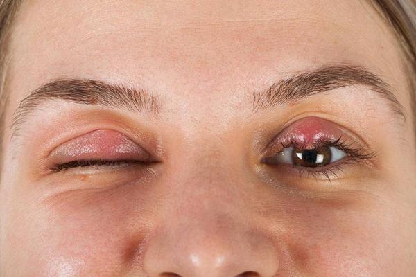 眼睛结膜炎的症状及治疗方法,眼睛得了结膜炎要多久才好