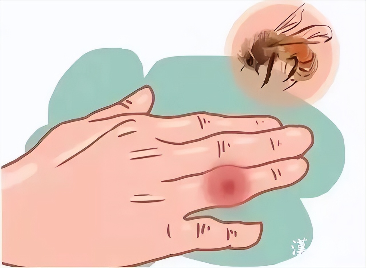 第1健康丨被“勤劳园丁”蜇伤，牢记4个急救原则