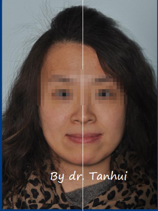 地包天能做手术矫正吗,儿童地包天矫正几岁做最好