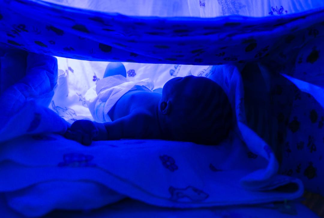 怎么黄疸照了蓝光后巩膜还是黄,婴儿黄疸巩膜黄染严重吗