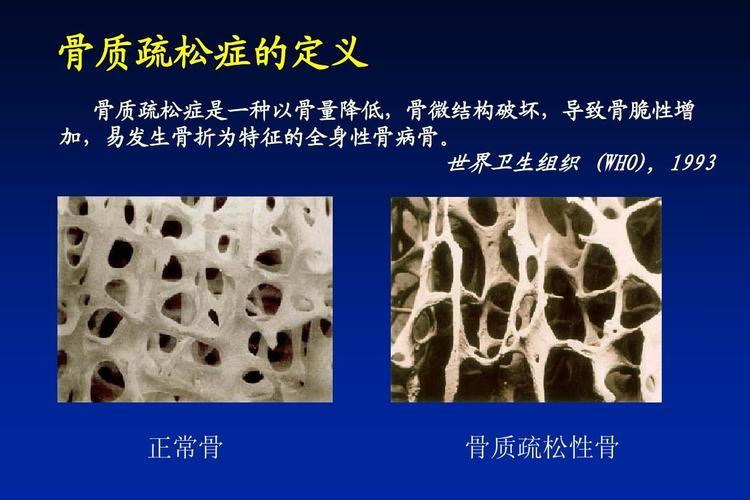 80多老年人骨质疏松骨折怎么治疗,老年人摔了一跤腿大筋疼