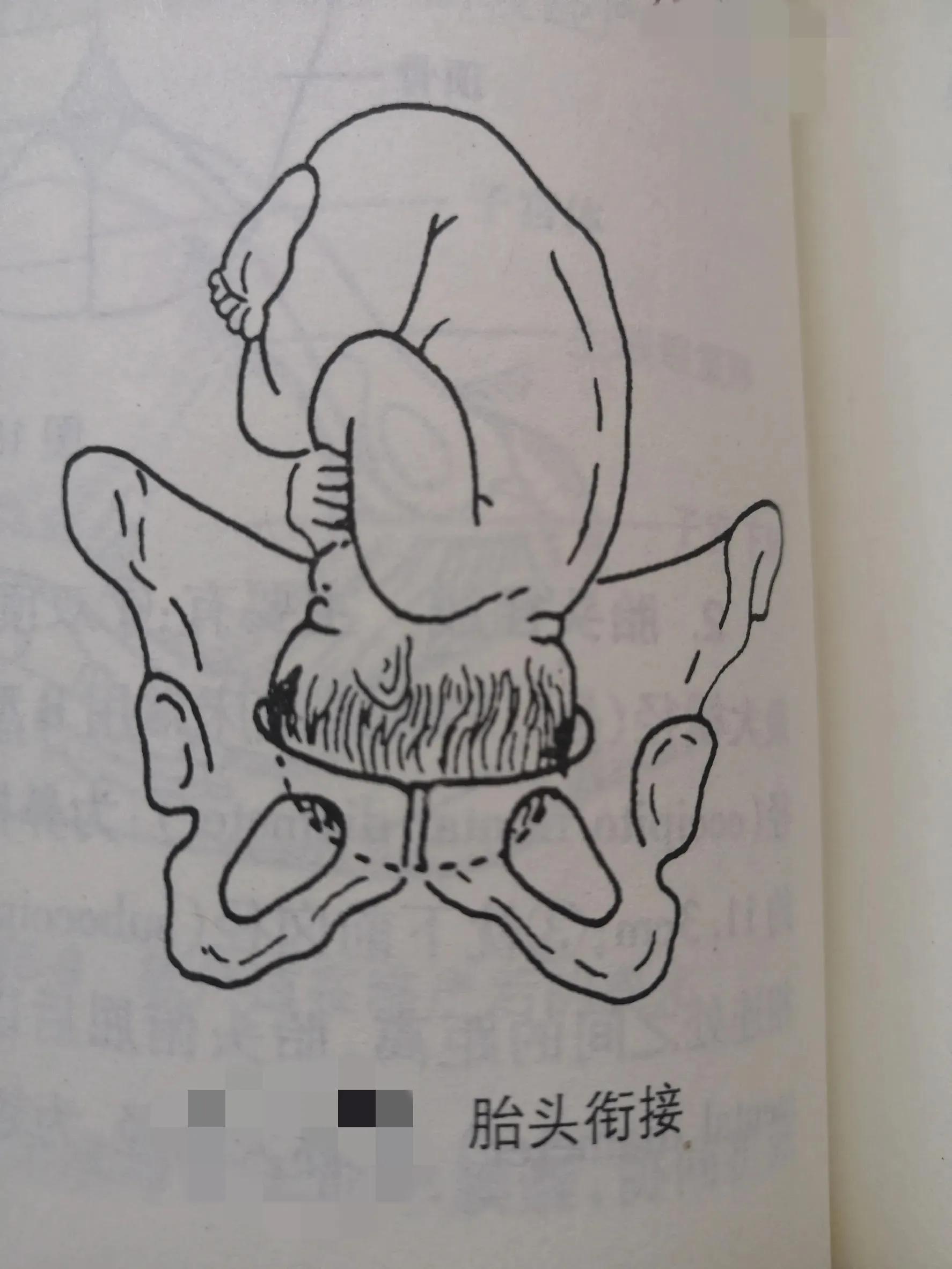 分娩基础知识,正常分娩胎儿的分娩机制