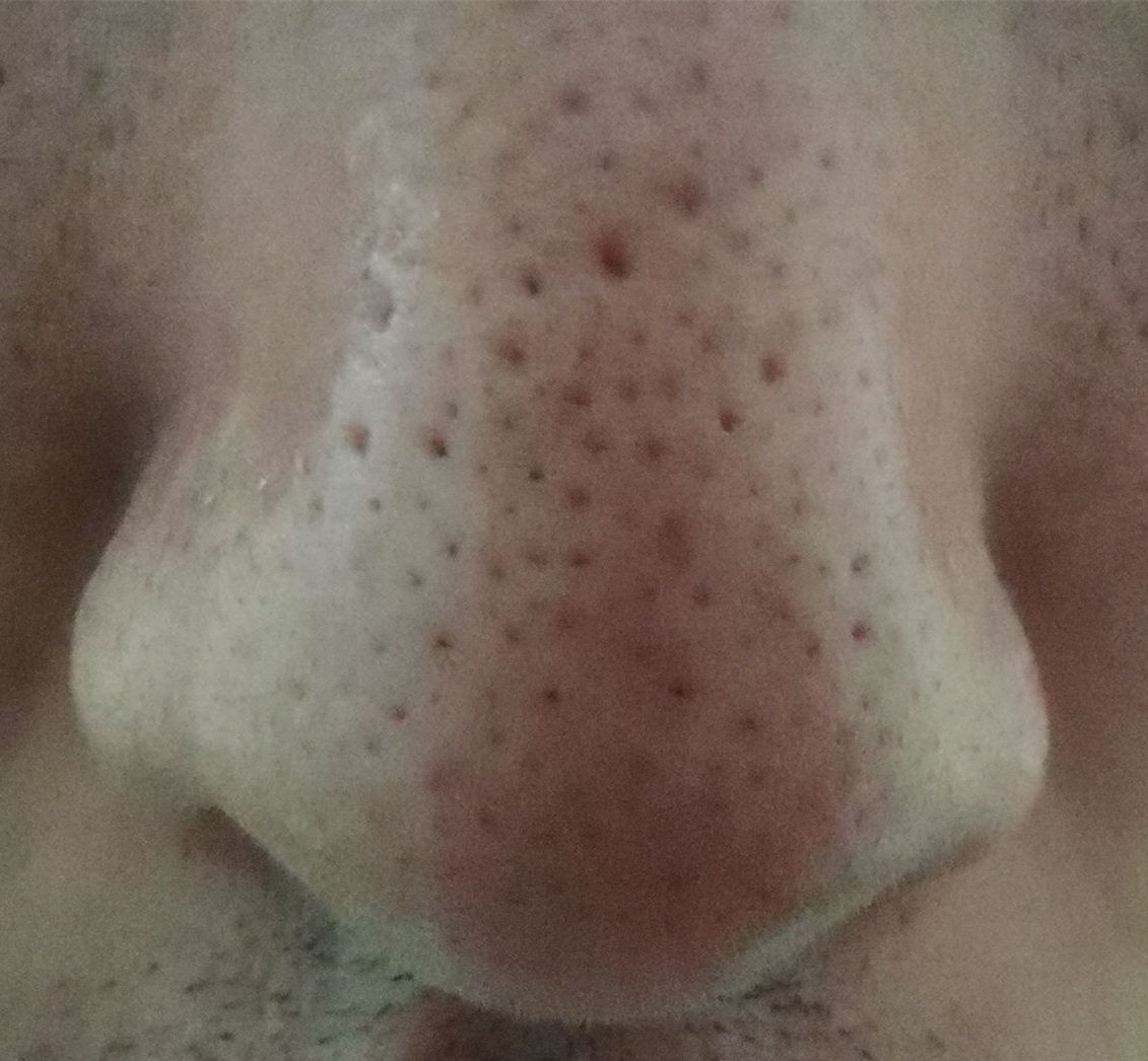 真黑头怎么去,黑头用黑头膏为什么去不掉黑头