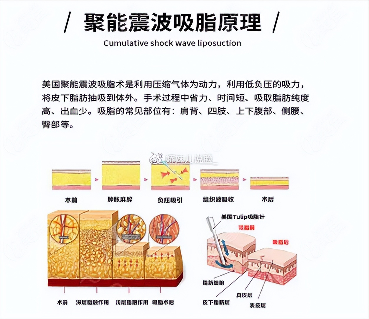 聚能震波吸脂对身体有影响吗,钻石精雕和聚能震波吸脂的区别