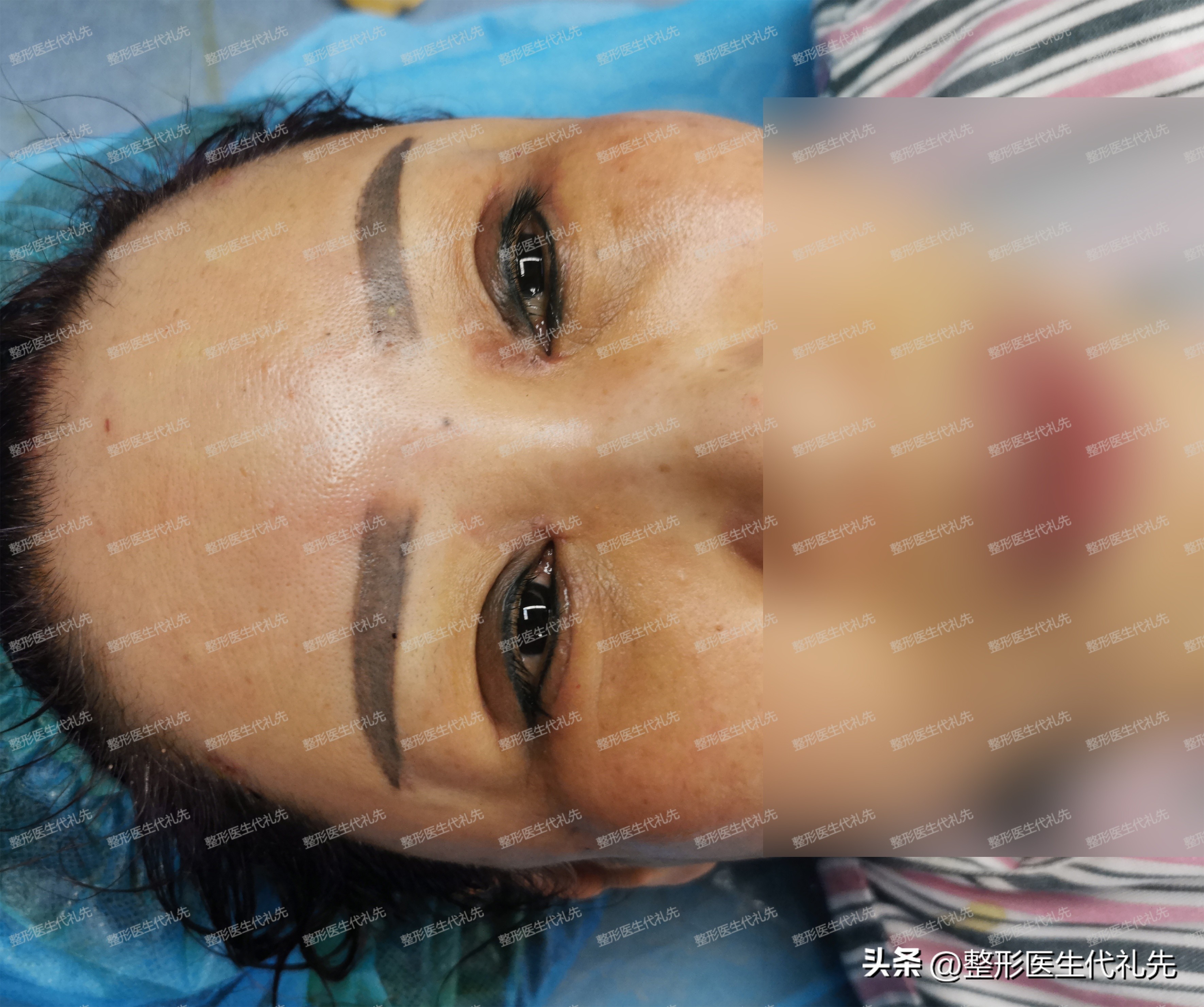 眼窝和法令纹凹陷很深怎么办,二十岁苹果肌饱满法令纹严重