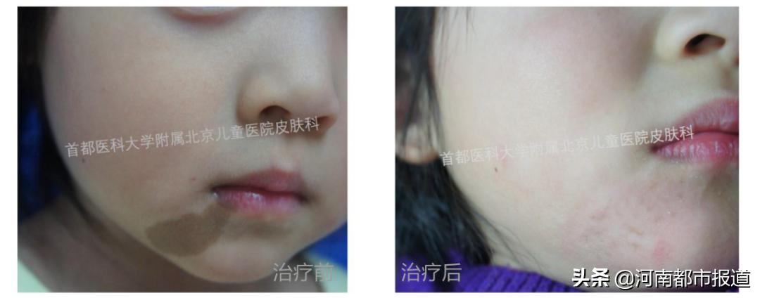 治疗只需要一束光！重新为女孩编织舞蹈梦