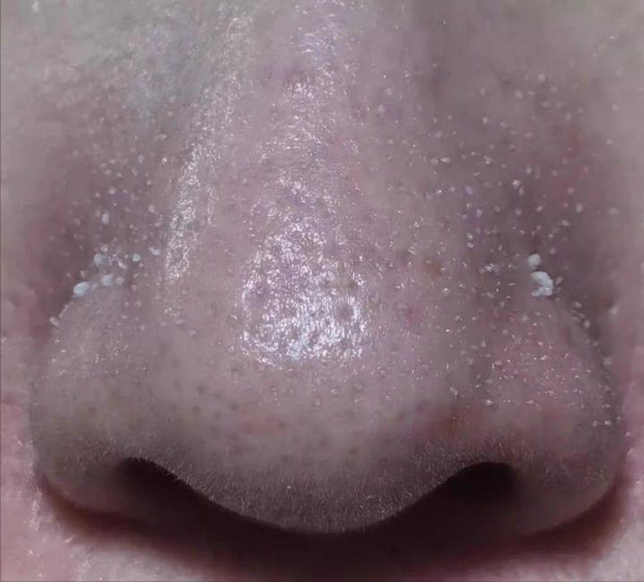 鼻子上有黑点怎么抠掉,鼻子边缘的小白点怎么去除