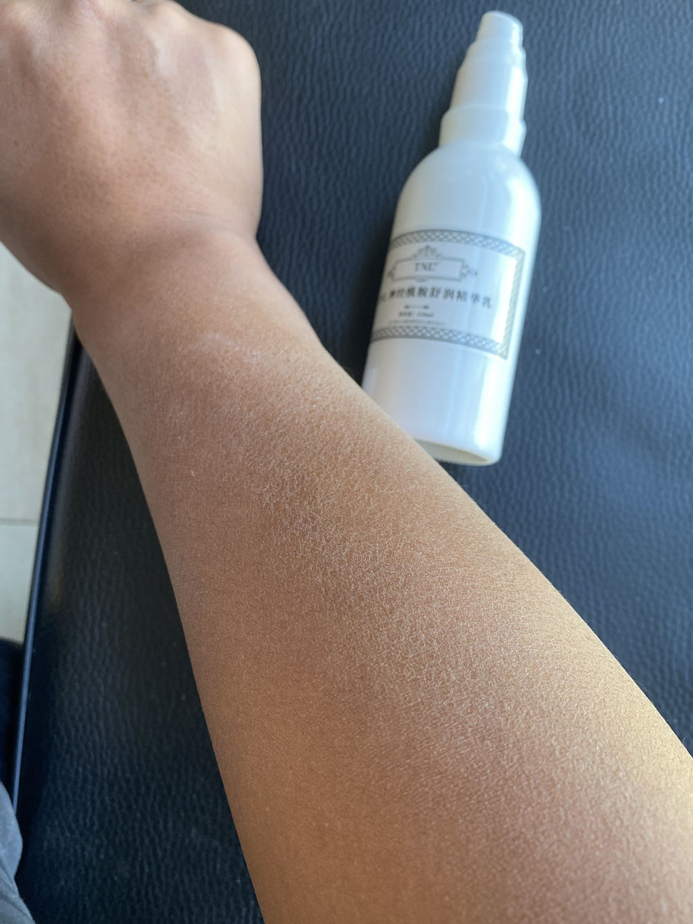 皮肤洗不干净老是脱皮,不洗澡身上晒得脱皮了怎么办