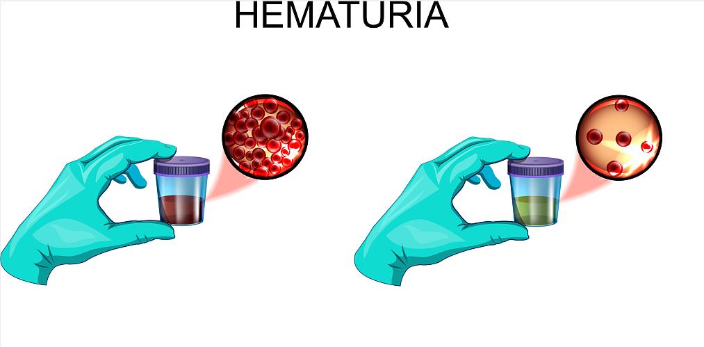 尿路感染有5种征兆,尿路感染有什么症状会有蛋白尿吗