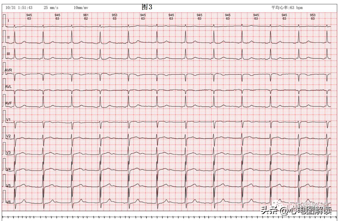 窦房结至心房之间的游走心律、房性心律的诱发原因之一