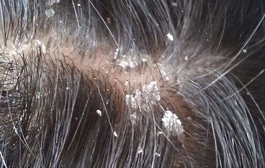 有头皮屑头皮痒以前没有头皮屑,头皮屑多头皮痒怎么治疗