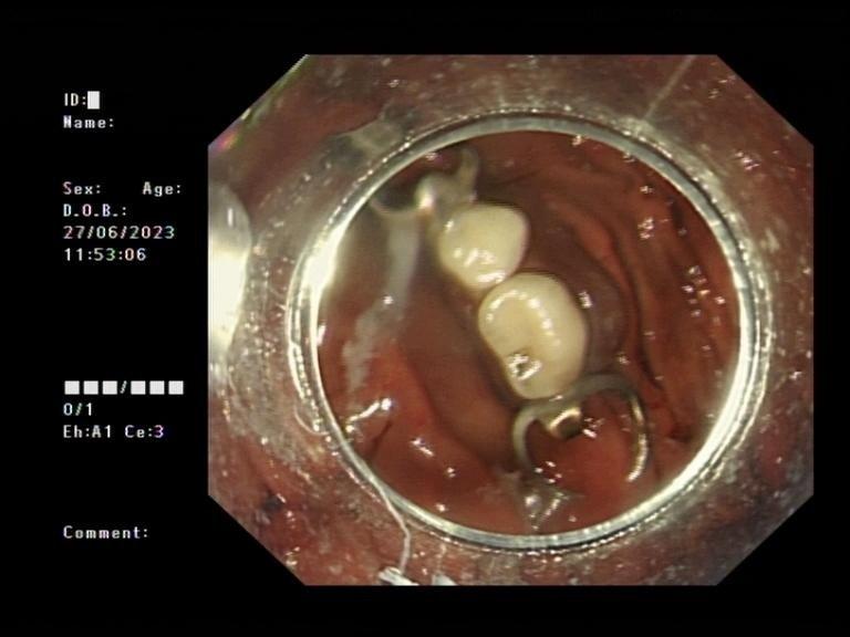 89岁老人吃饭突然不“香”了，原来是假牙吞进肚子里