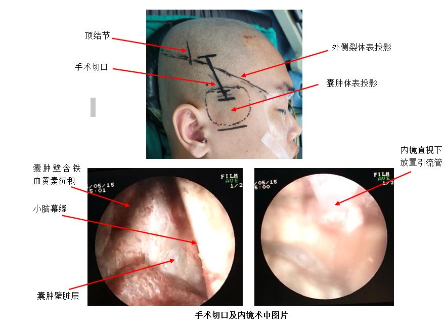 蛛网膜囊肿引起硬膜下血肿,蛛网膜囊肿造瘘术后硬膜下血肿