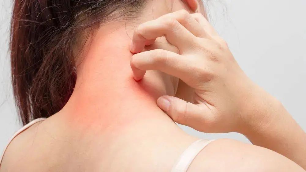 一到晚上皮肤就瘙痒荨麻疹,荨麻疹一到晚上就全身痒怎么调理