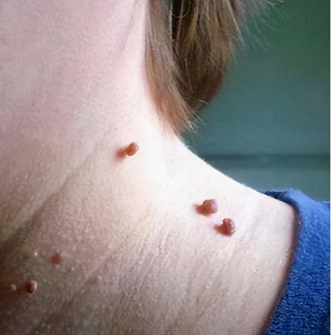 脖子上长小肉疙瘩丝状疣怎么治疗,脖子上长小肉疣怎么治疗