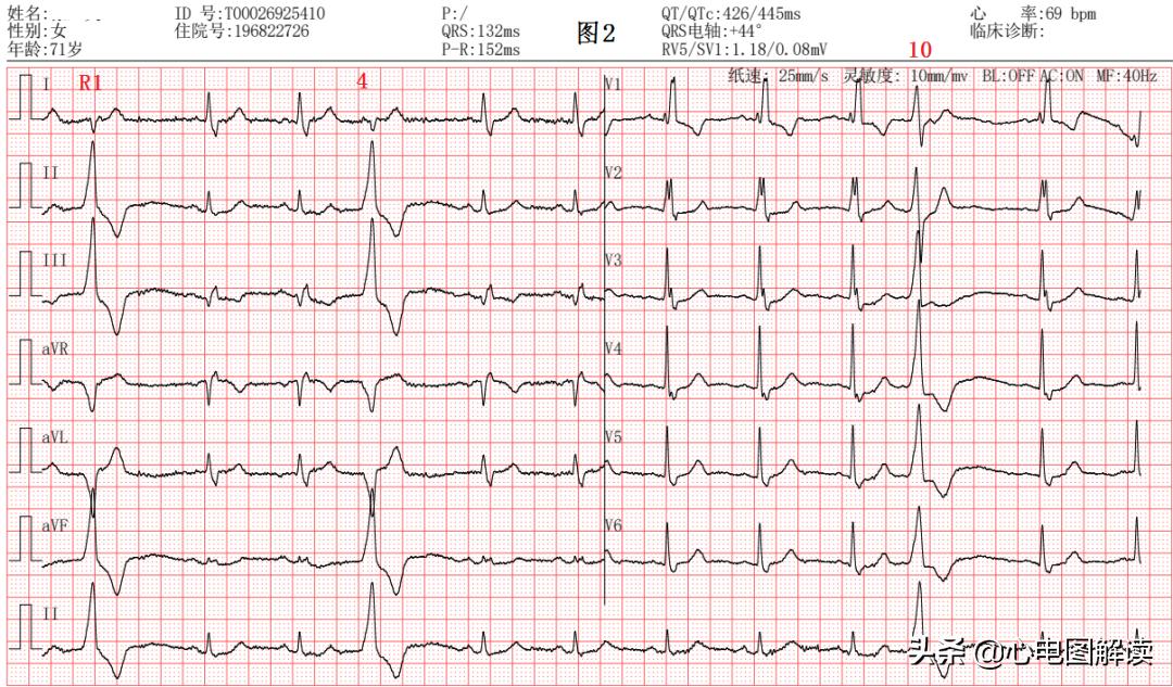 完全性右束支阻滞和t波改变,完全性右束支传导阻滞和t波改变