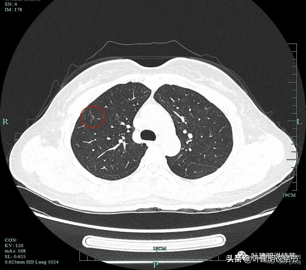 磨玻璃结节伴有增生是癌症吗,磨玻璃结节会是别的癌转移的吗