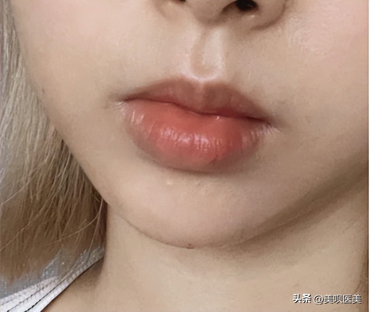 市面上假的玻尿酸打了会怎么样,假玻尿酸毁容案例