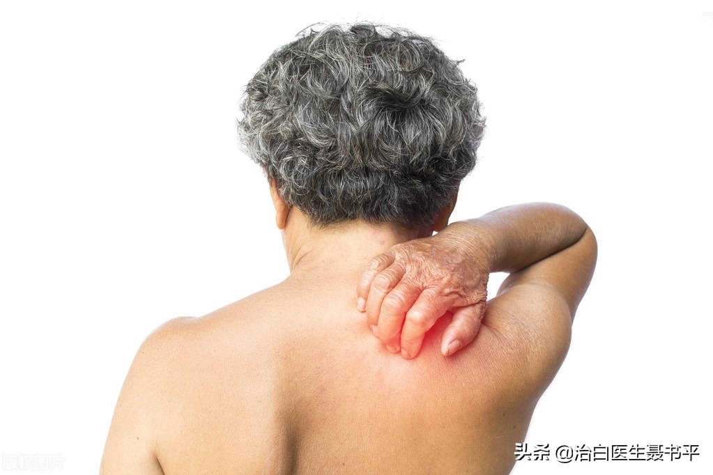 白斑发痒是好转的迹象,不疼也不痒的白斑是怎么回事