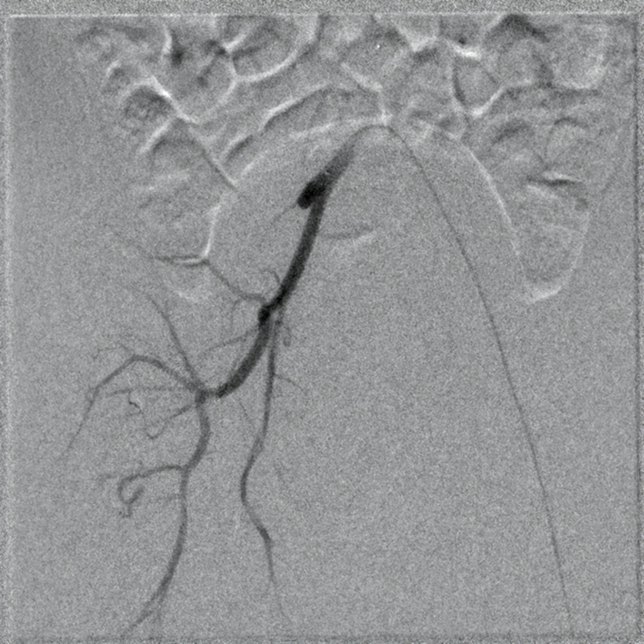 儿童下肢动脉闭塞症,儿童下肢血管狭窄怎么治疗
