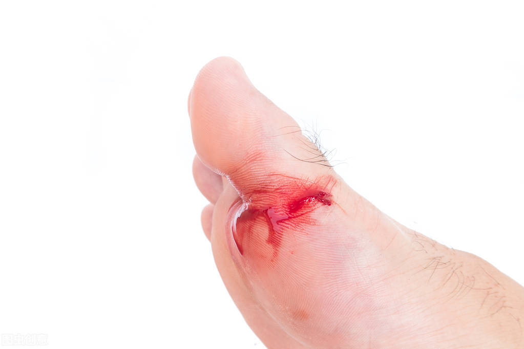 犯脚气什么原因,脚气原因是什么引起的