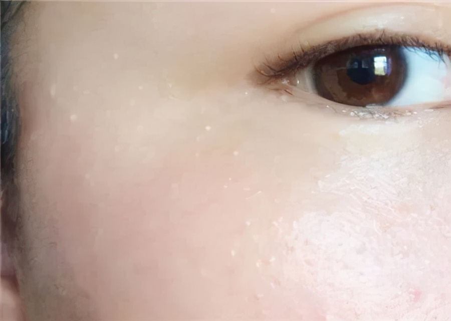 脂肪粒和闭口长什么样,脂肪粒闭口长啥样的