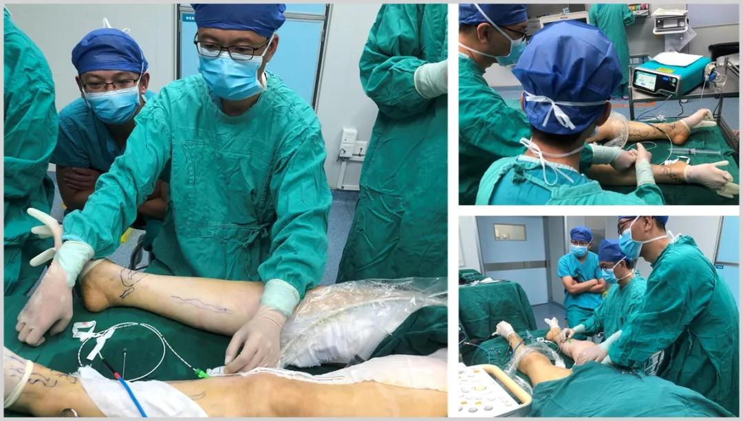 天气冷静脉曲张怎么调理,高温天气怎么避免静脉曲张