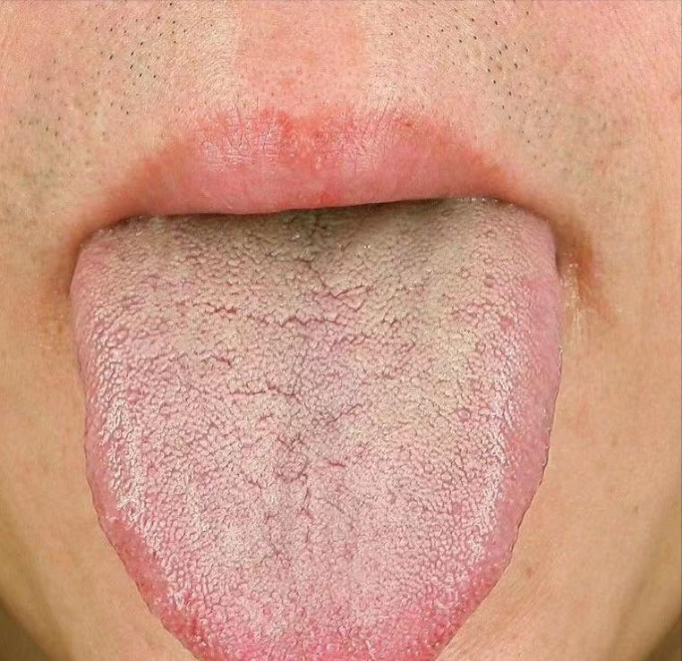 新冠二阳退烧后喉咙疼,二羊中医治疗新冠古方