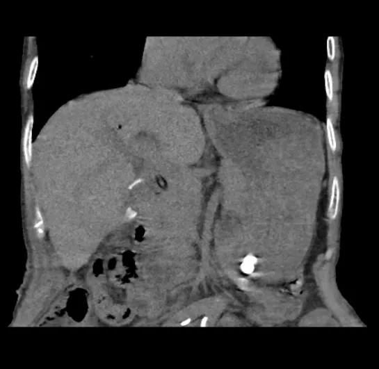 微创跟单孔腹腔镜的区别,微创腹腔镜单孔取胆结石
