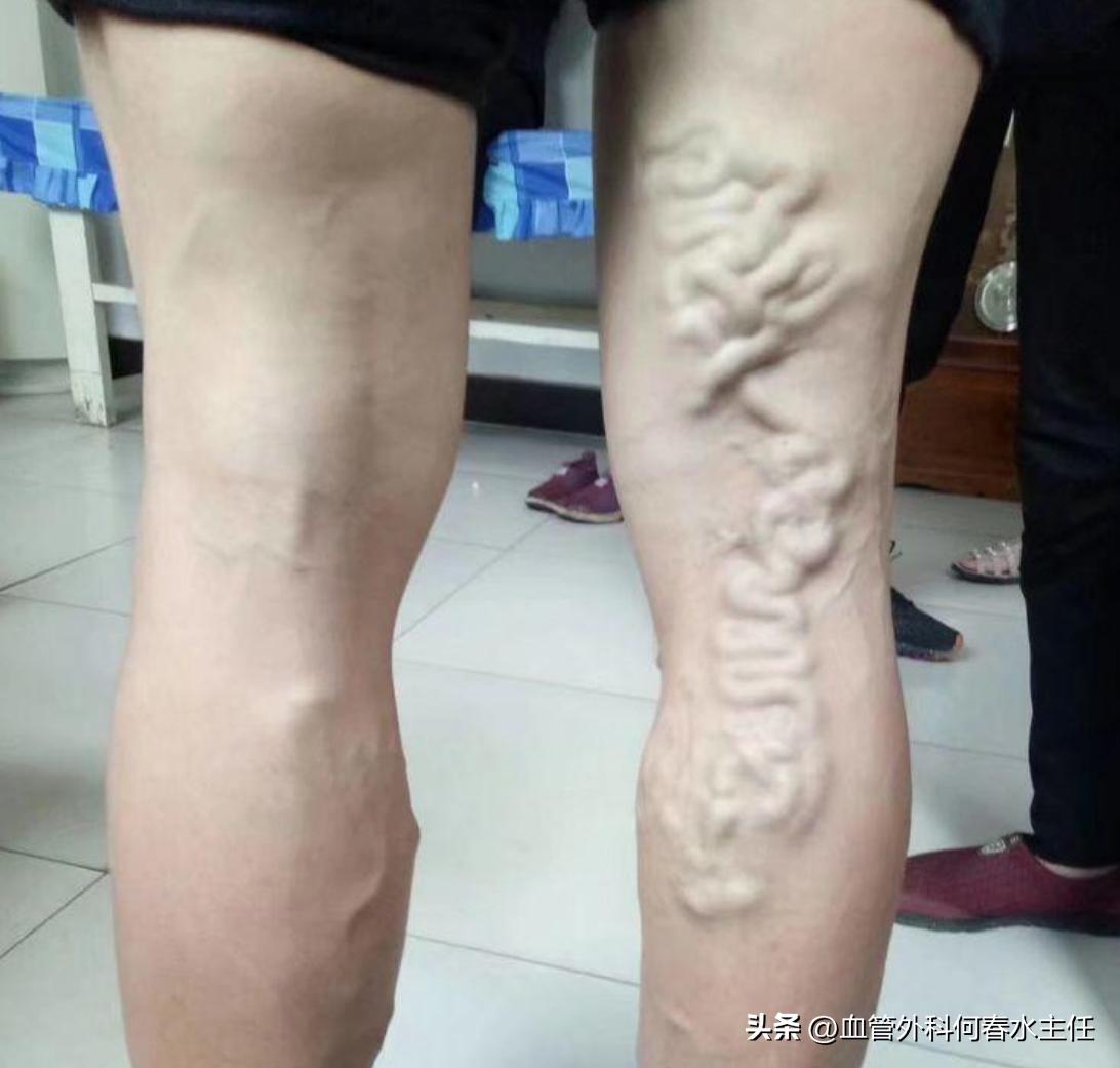 静脉曲张的10个早期症状图解,请问医生静脉曲张有哪些症状