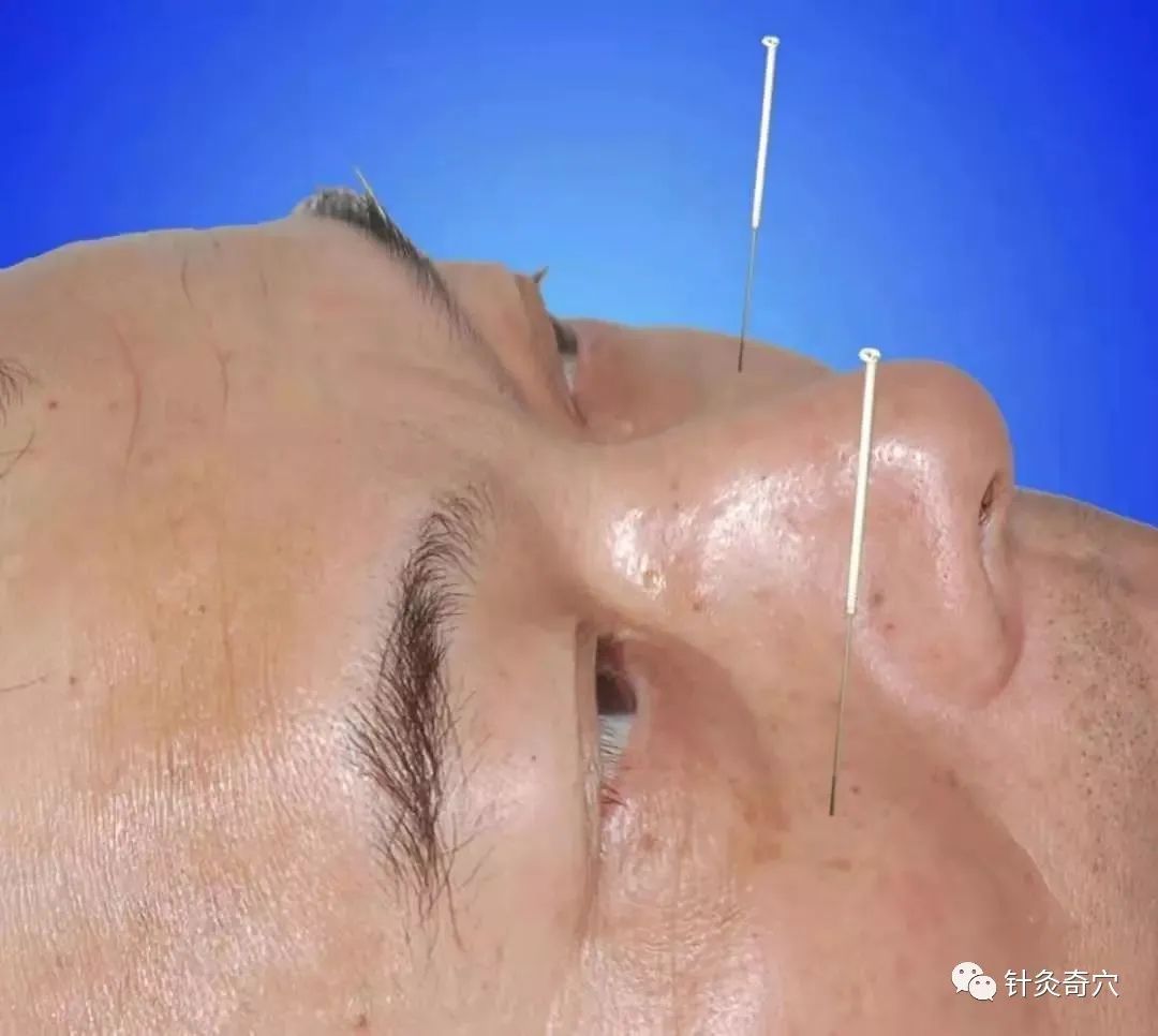 史上最全中医针灸视频教程全集,针灸治疗真实图片大全