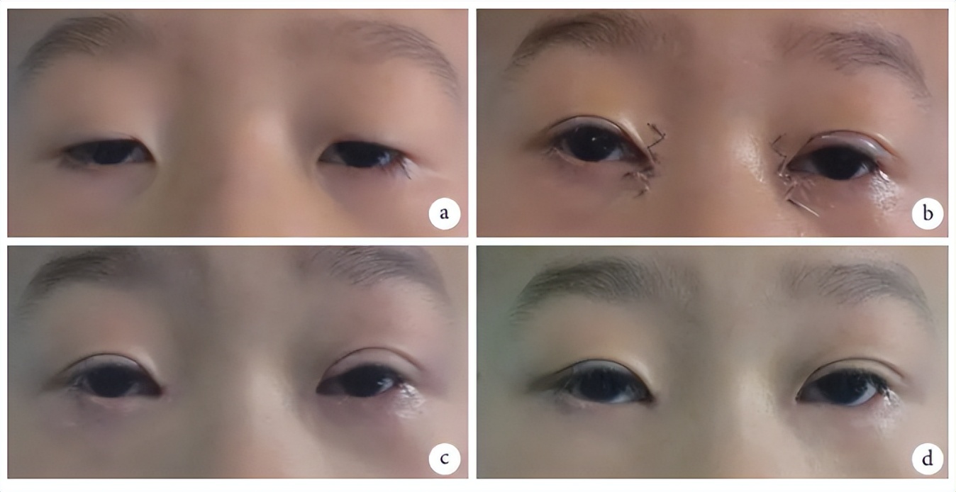 河南两兄弟割双眼皮被劝退,郑州割双眼皮失败男子