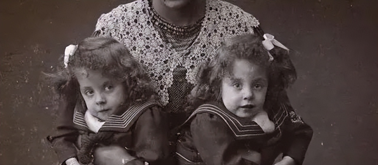 英国连体姐妹分离手术大结局,英国连体姐妹姐姐死后怎样