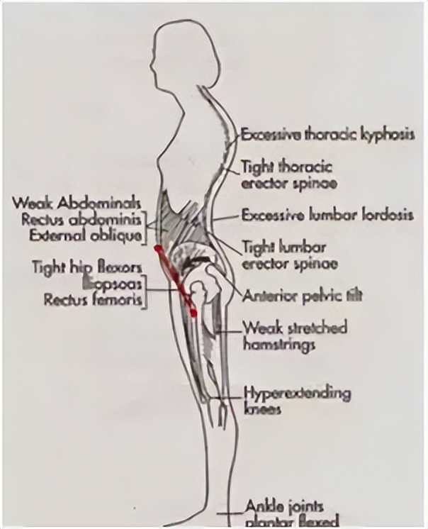 矫正骨盆后倾其实很简单,骨盆后倾矫正最简单的动作