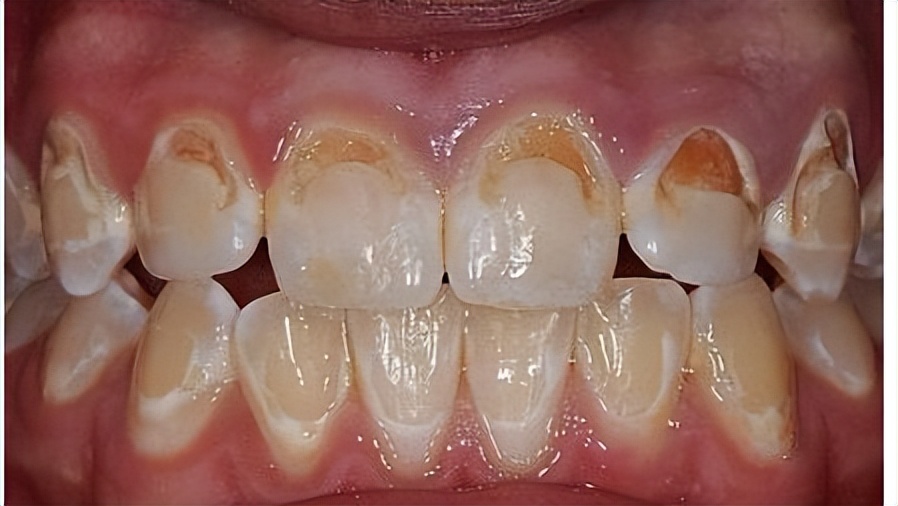 牙齿矫正期间如何让牙齿不变黄,牙齿做完矫正之后变黄了怎么办