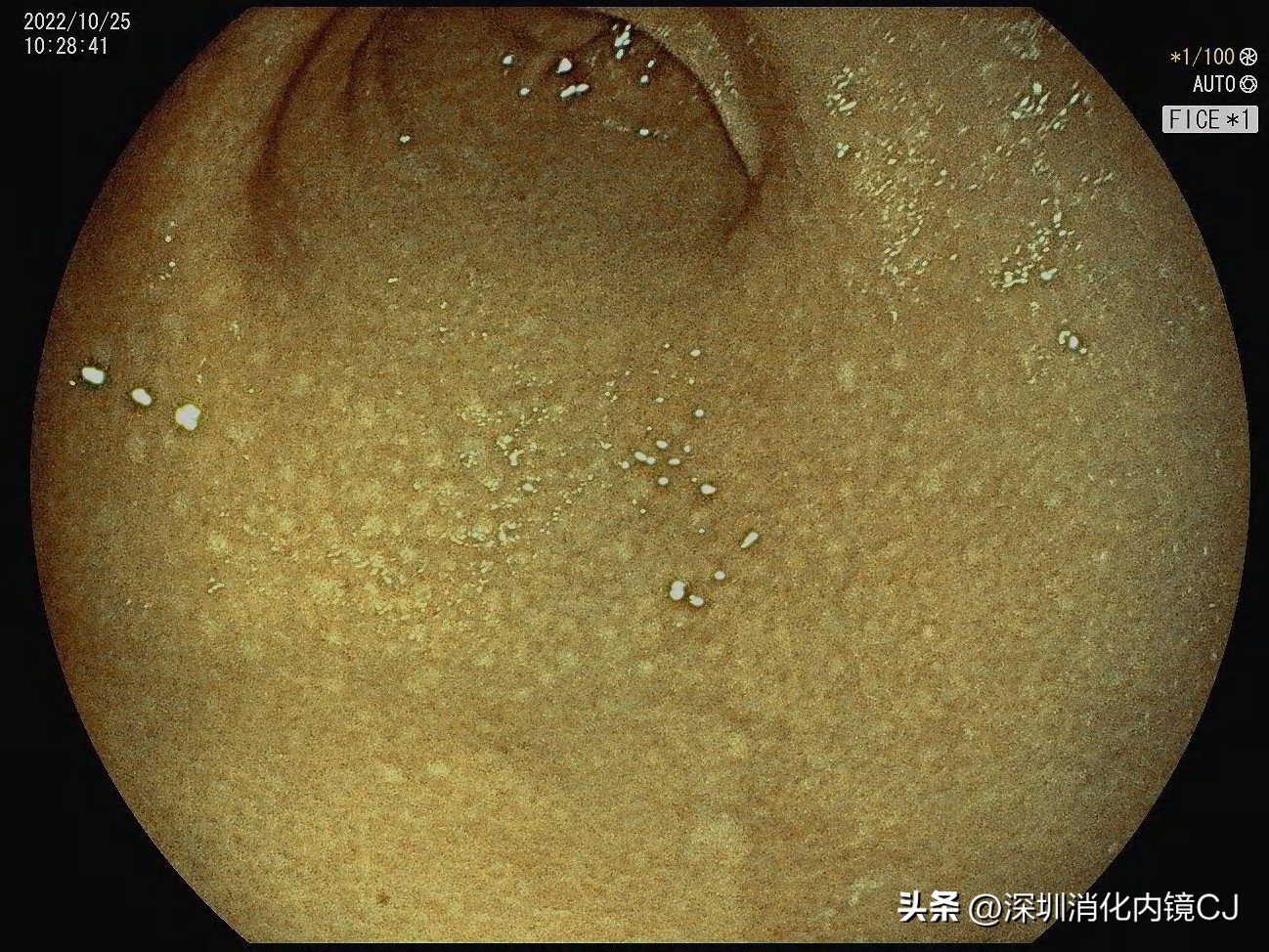 幽门螺旋杆菌感染胃粘膜表现,没有幽门杆菌但是胃窦鸡皮样改变