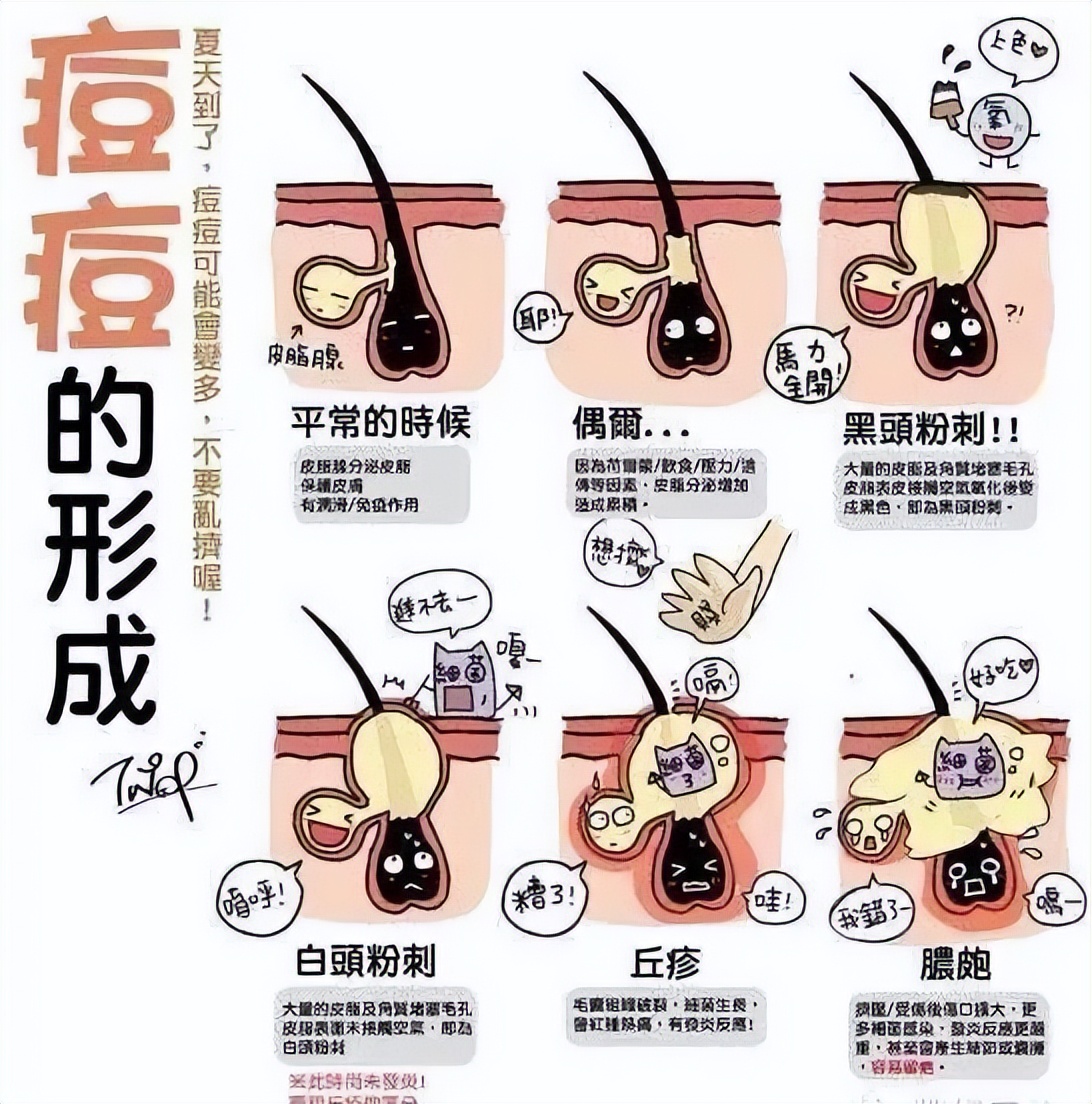 脸上有痘痘用日常方法解决,脸上长了一个痘痘的正确处理方法