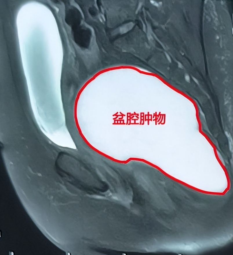 多学科精准诊断罕见巨大腹膜后肿物哈医大一院群力普外科赵宪琪团队微创拆除18厘米“*弹炸**”