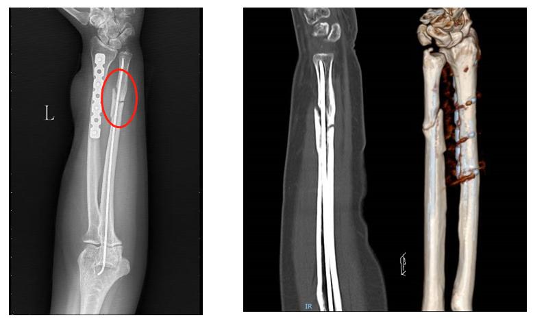 治疗骨折新技术,微创手术治疗骨折的方法