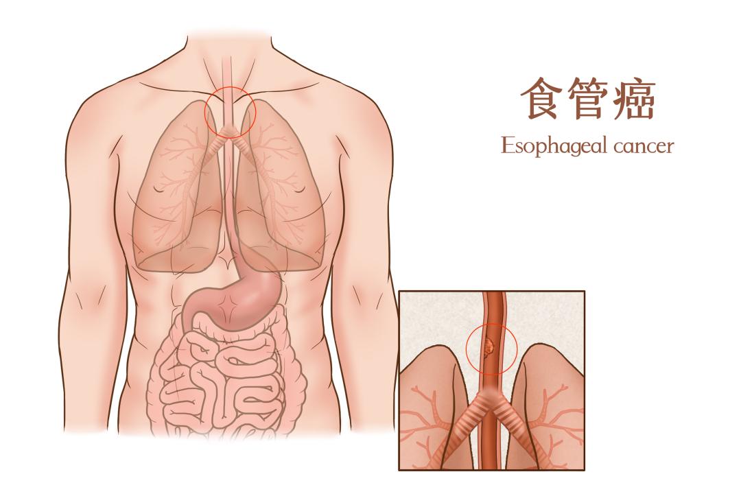 喉咙出现这些症状别大意！不是“咽炎”，可能是癌症上身！