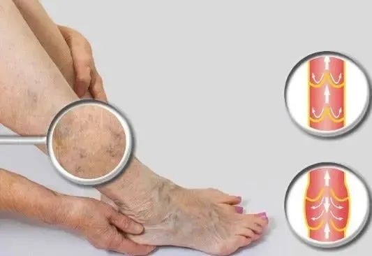 天气冷静脉曲张怎么调理,高温天气怎么避免静脉曲张