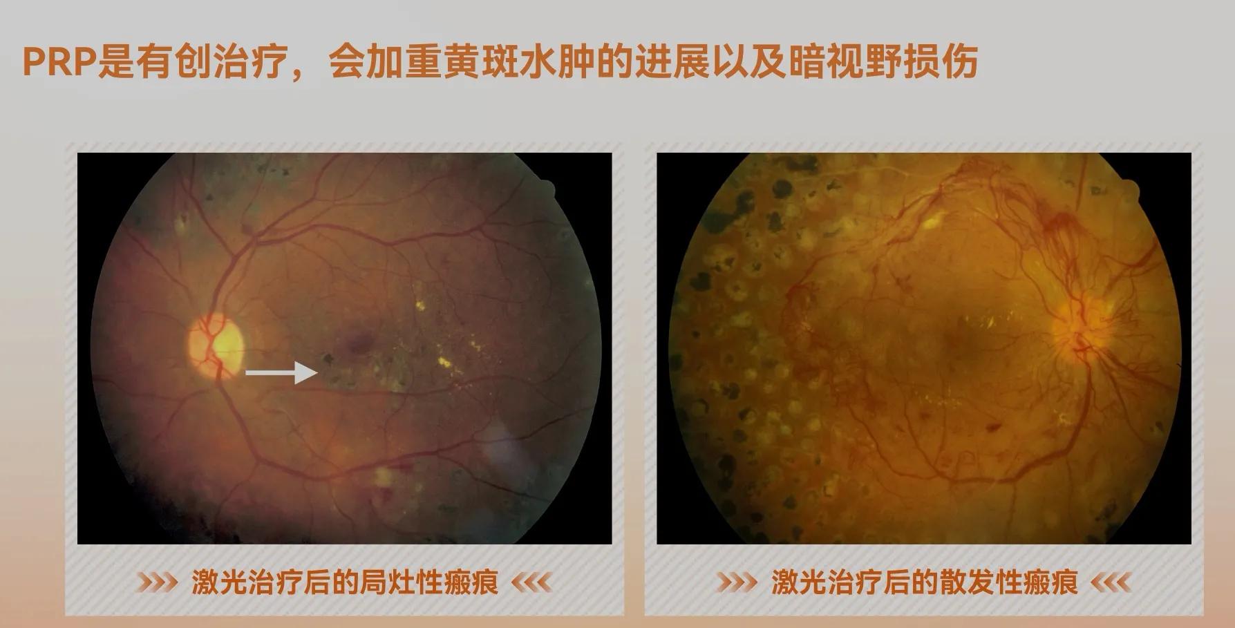 眼科抗vegf治疗,抗vegf治疗眼底要打几针